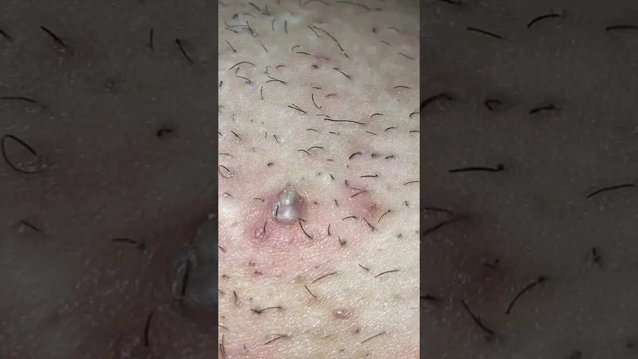 Remoção de Cravos e Espinhas - Remove Squeezing Blackheads and Pimples - Just Relax | Apenas Relaxe