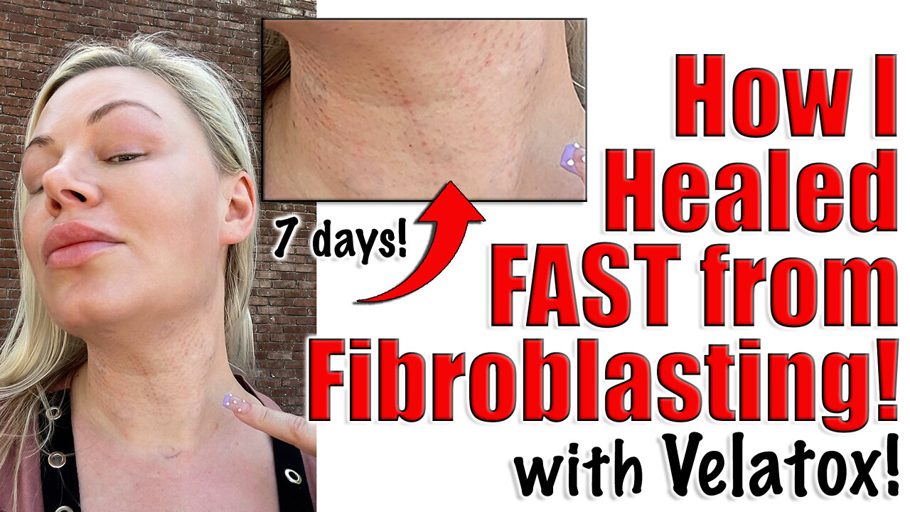 How I Healed FAST from Fibroblasting with Velatox from Acecosm.com | Code Jessica10 saves You Money