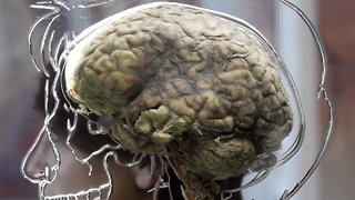 Is The Herpes Virus A Key To Curing Alzheimer's Disease?