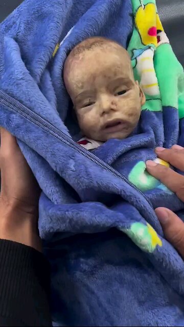 A 6-month-old baby died this morning at the Al-Ahli Hospital in Gaza City. lack of medicine ⏬⏬descp