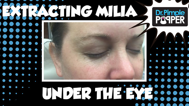 Extracting a Milia under the eye