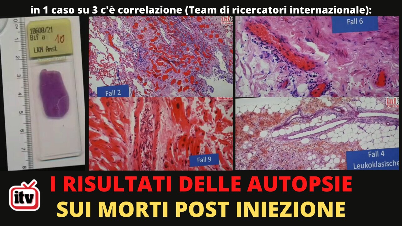 AUTOPSIE MORTI POST VACCINAZIONE: I RISULTATI DI UN TEAM INTERNAZIONALE