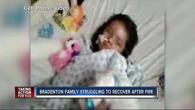 Little girl severely burned in Bradenton house fire improving