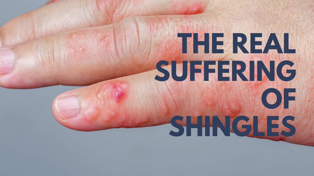 The Real Suffering of Shingles