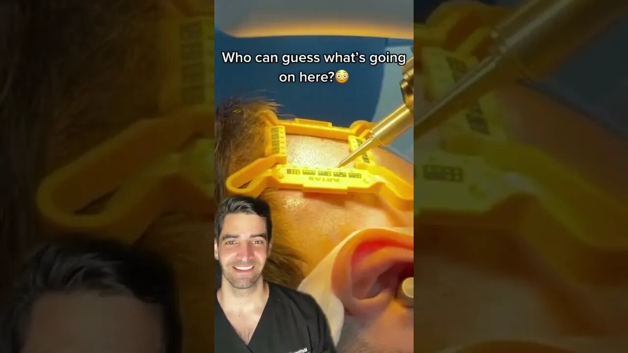 Hair transplant