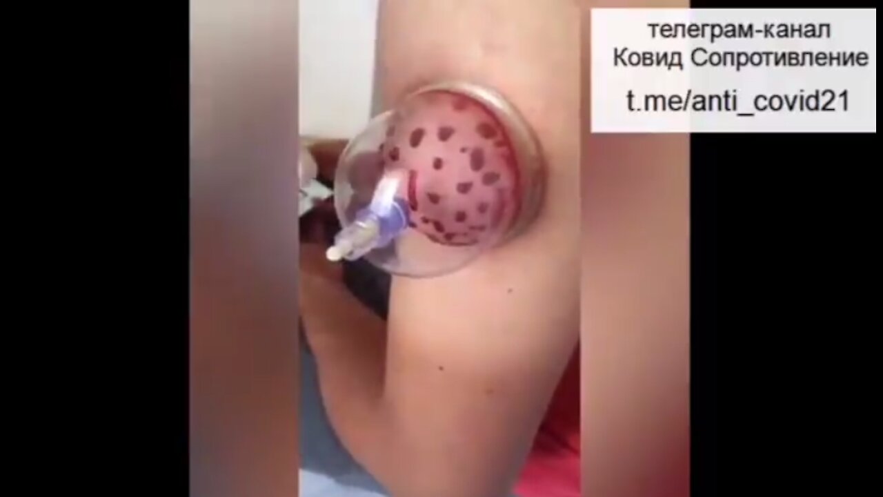 How to remove a big portion of the Covid "vaccine" from your body with cupping