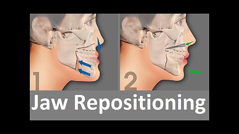 Repositioning of the Jaw by Prof John Mew