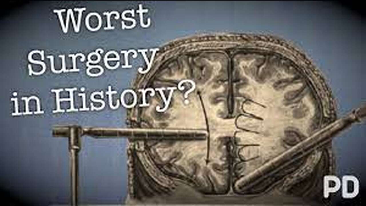 The Dark side of Science: The Lobotomy, the worst surgery in history? #Documentary