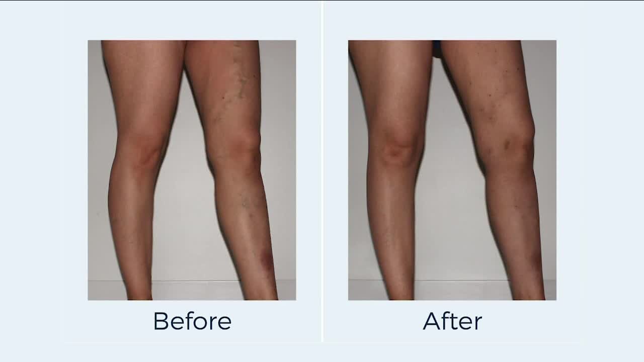 Take Back Your Legs // American Vein & Vascular Institute