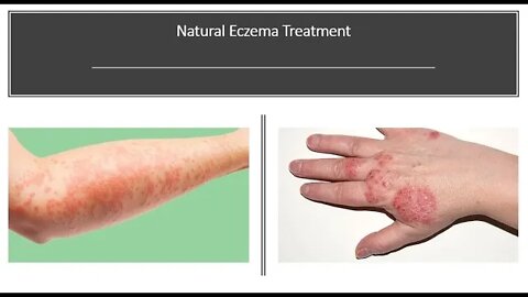 Eczema - Natural Treatment & Herbal Medicine