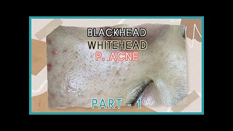 Big Cystic Acne Blackheads Extraction Blackheads & Milia, Whiteheads Removal Pimple Popping