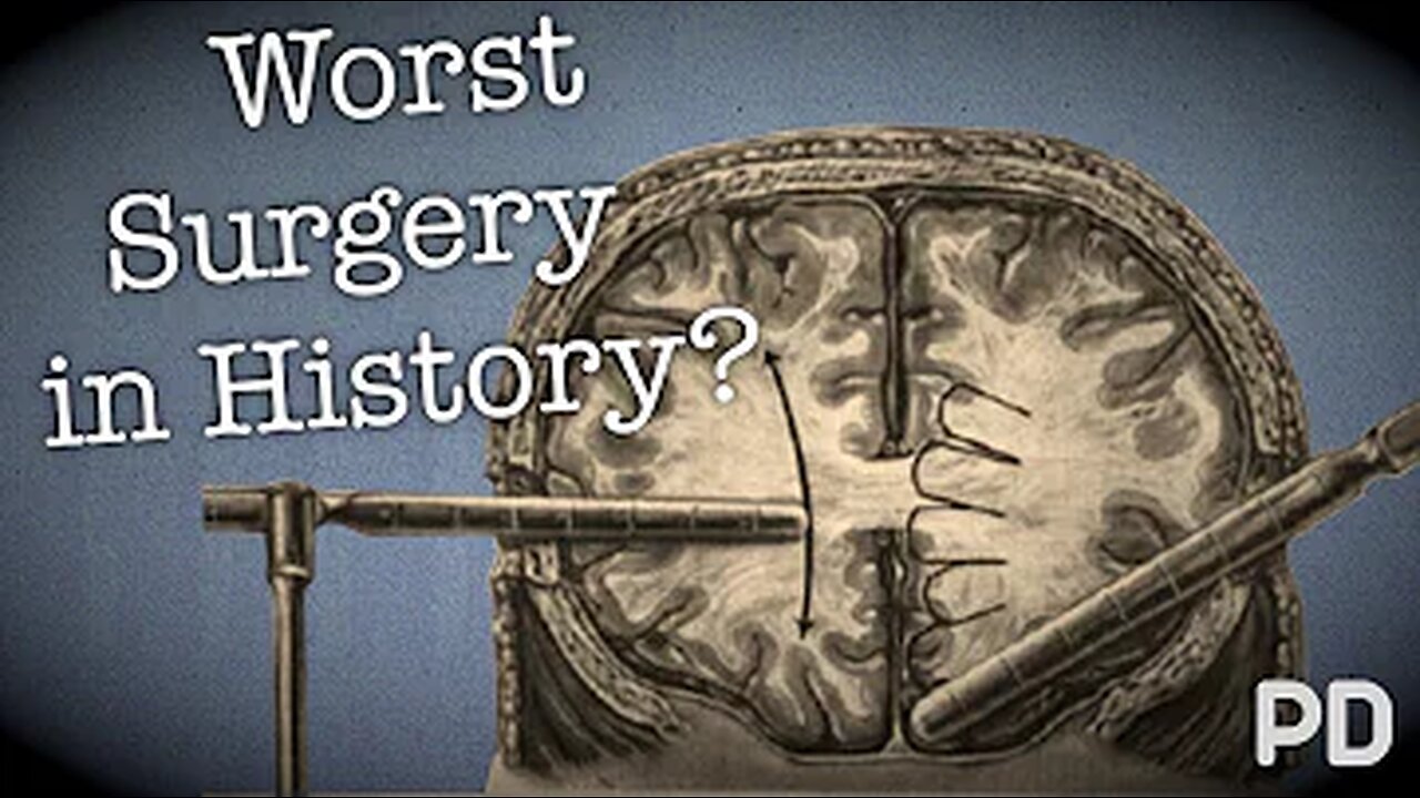 The Dark side of Science: The Lobotomy, the worst surgery in history? (Documentary)