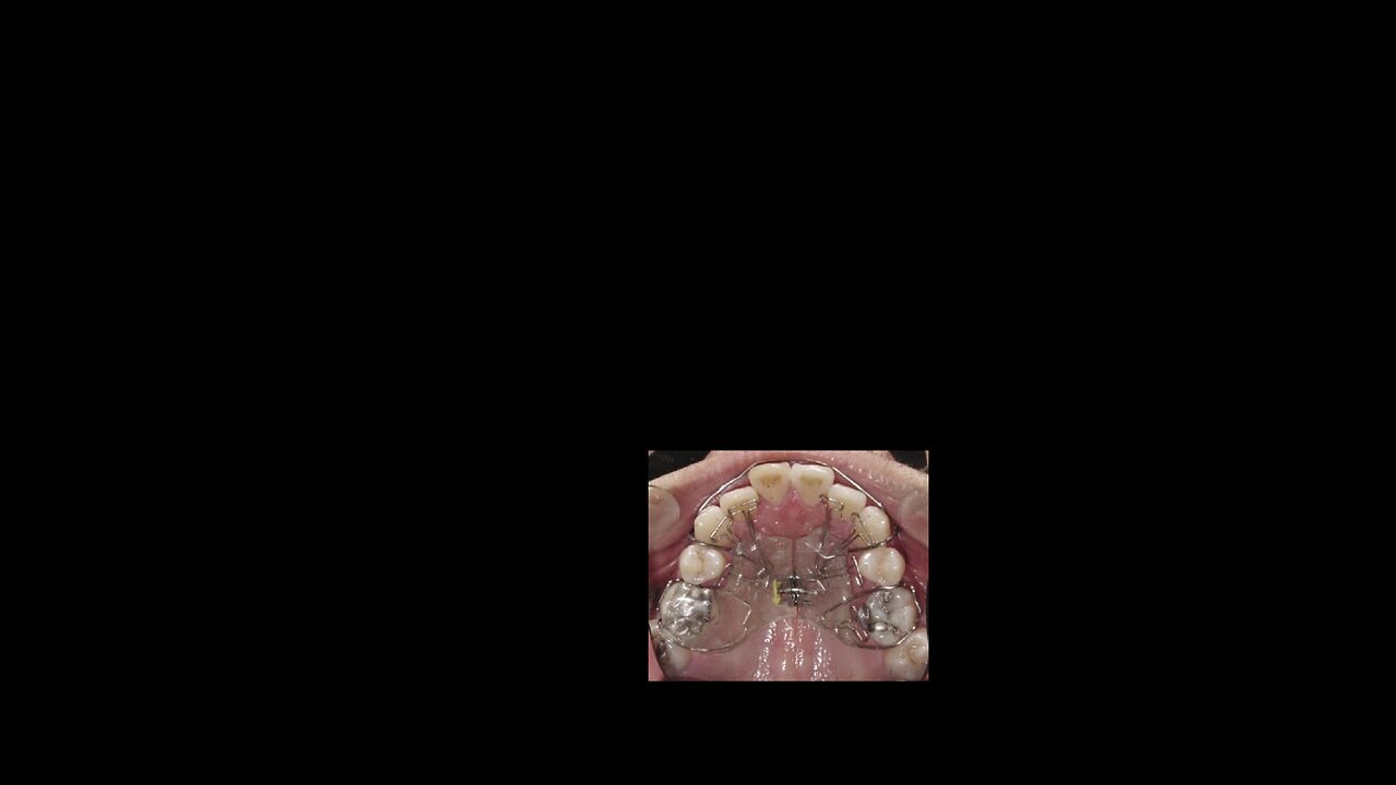 Correcting the Position of Jaws with Homeoblock Appliance by Prof John Mew