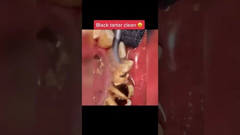 Black Tartar Removal - Teeth Surgery #satisfying