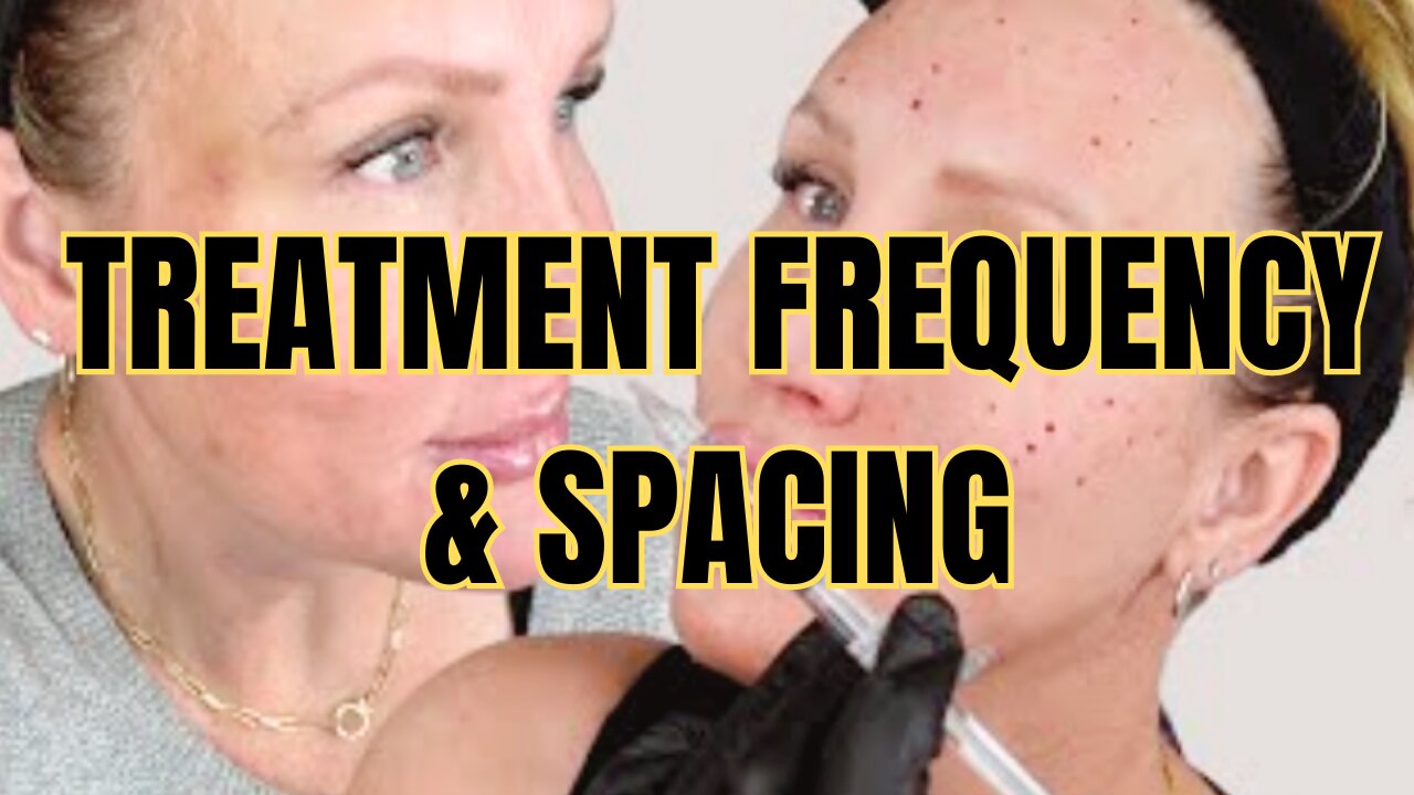 Treatment Spacing // How often // Facial Rejuvenation