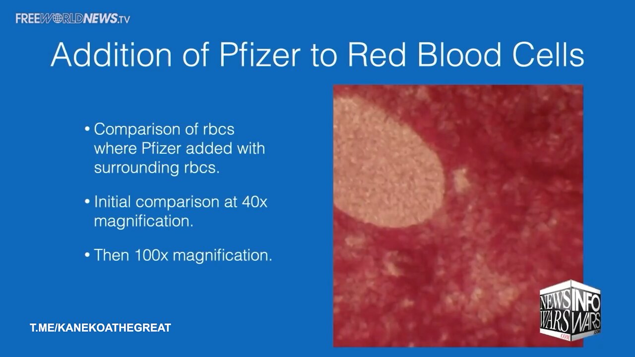 Dr. Richard Fleming: Pfizer Vaccine Causes Blood Clots Under Microscope