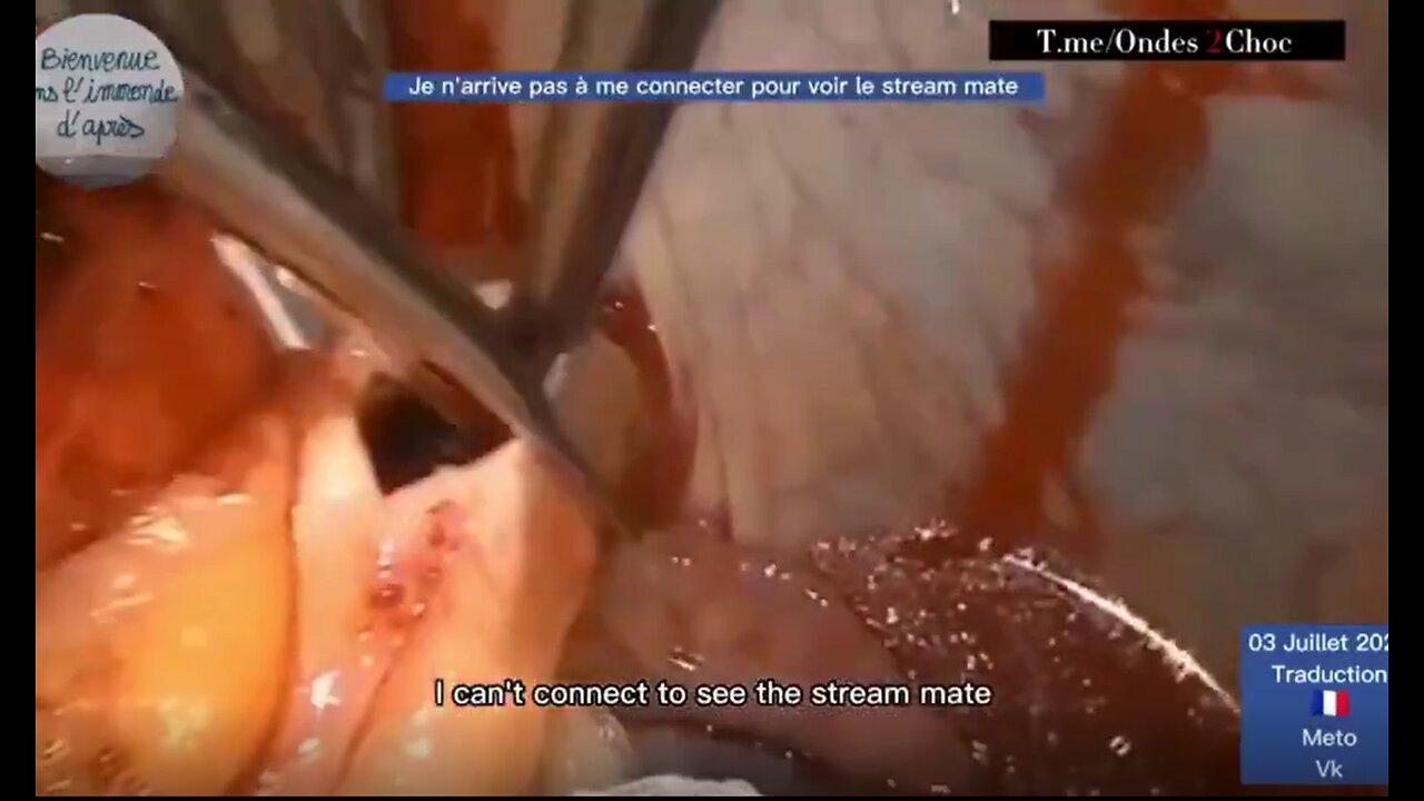 Blood clot removed from a beating heart in a fully vaccinated patient - 7-30-22