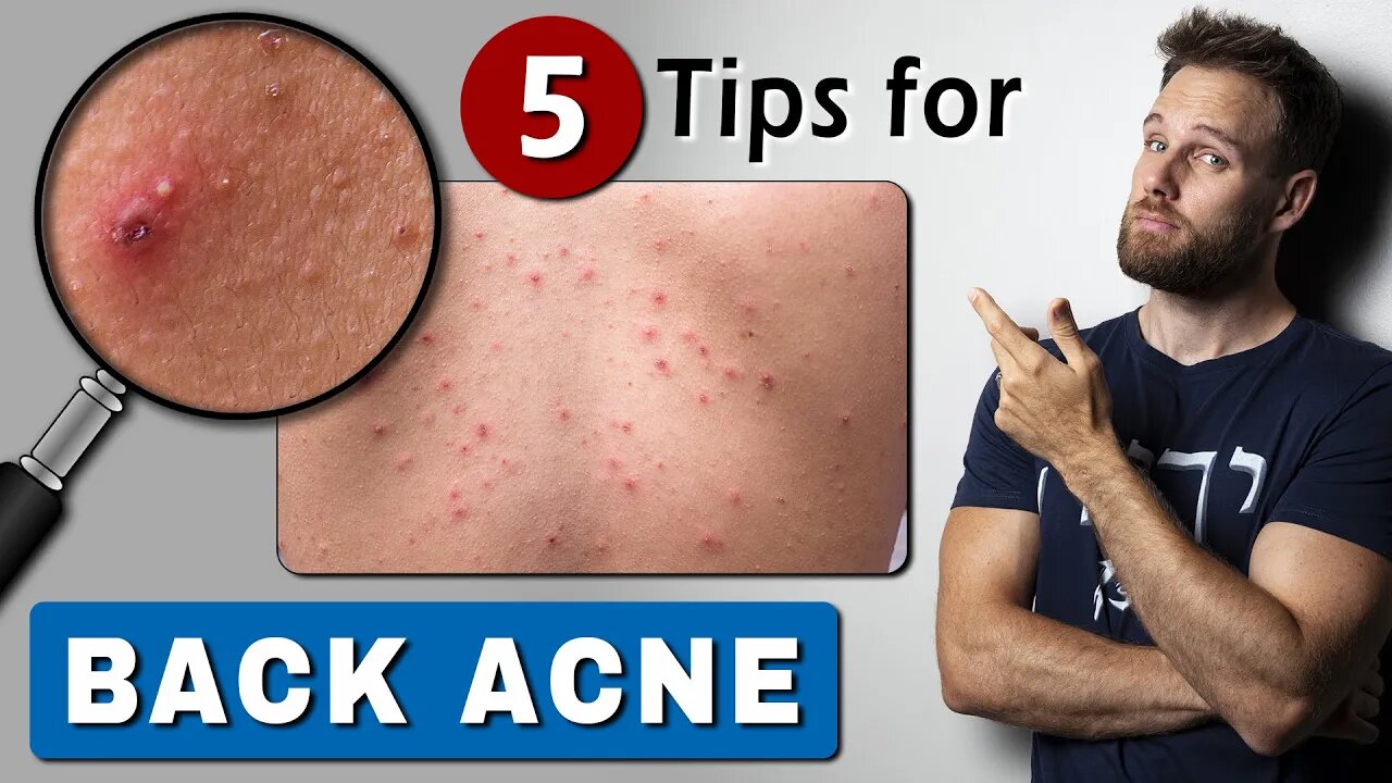 How to GET RID of BACK ACNE fast & easy!