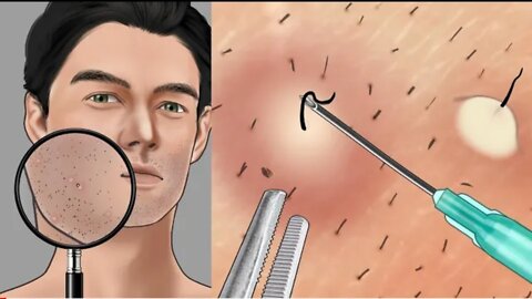 ingrown hair animation