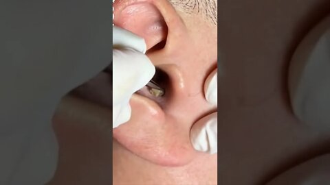 Huge deep blackhead inside the ear gets professionally removed 😨🫣 #blackheadremoval #blackhead