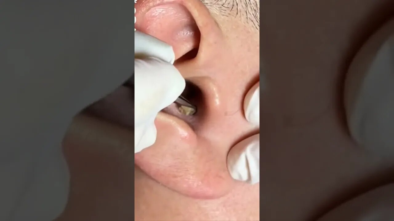 Huge deep blackhead inside the ear gets professionally removed 😨🫣 #blackheadremoval #blackhead