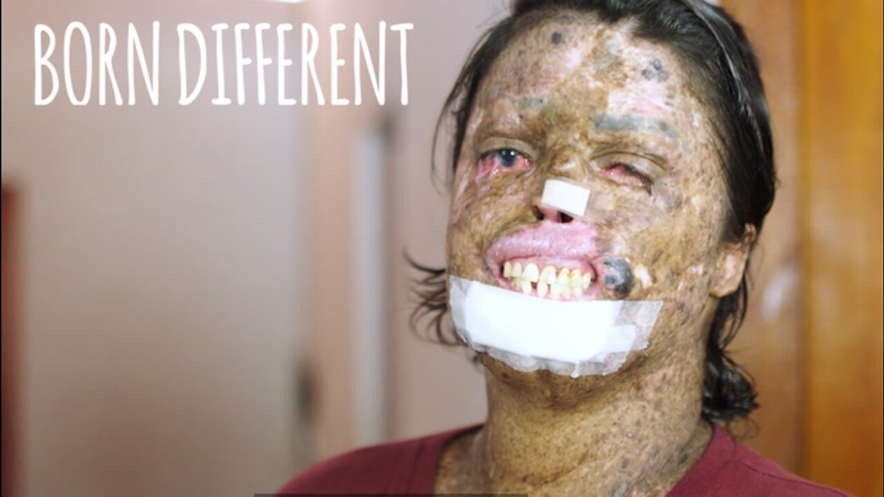 The Woman Who Is Allergic To Sunlight | BORN DIFFERENT