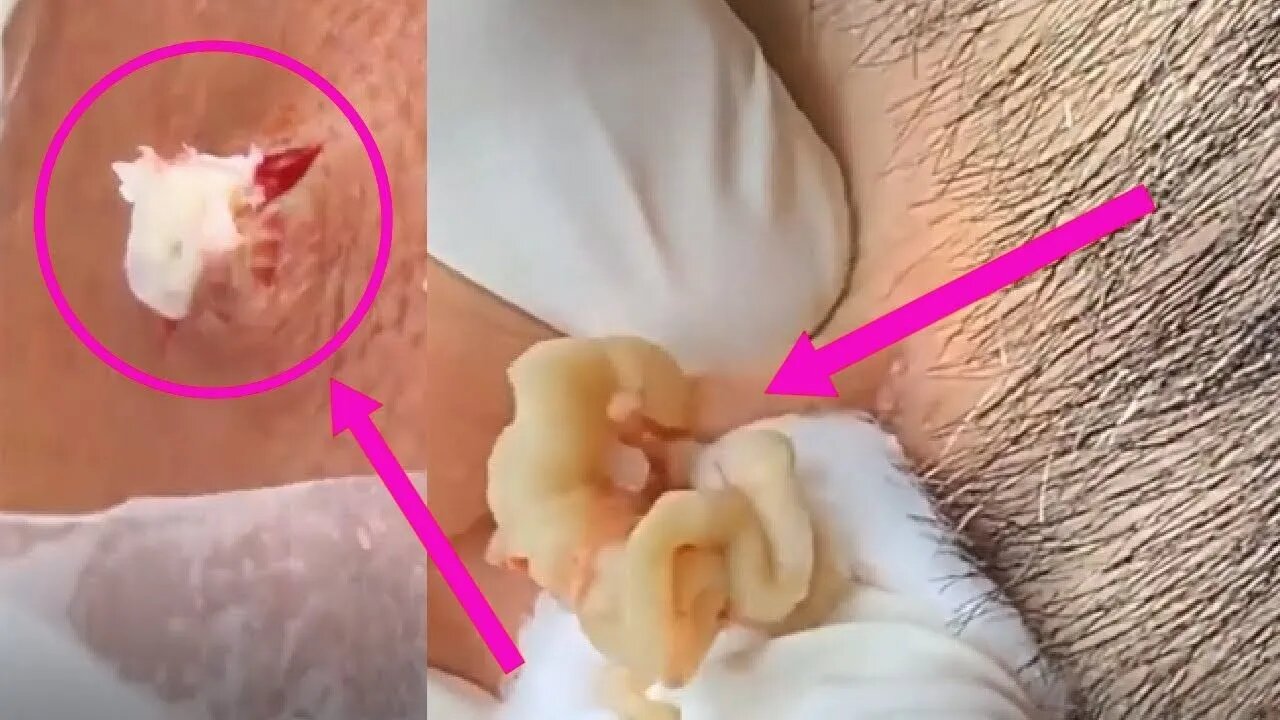 Big cyst! Relax watching! Blackhead Whitehead Cravo