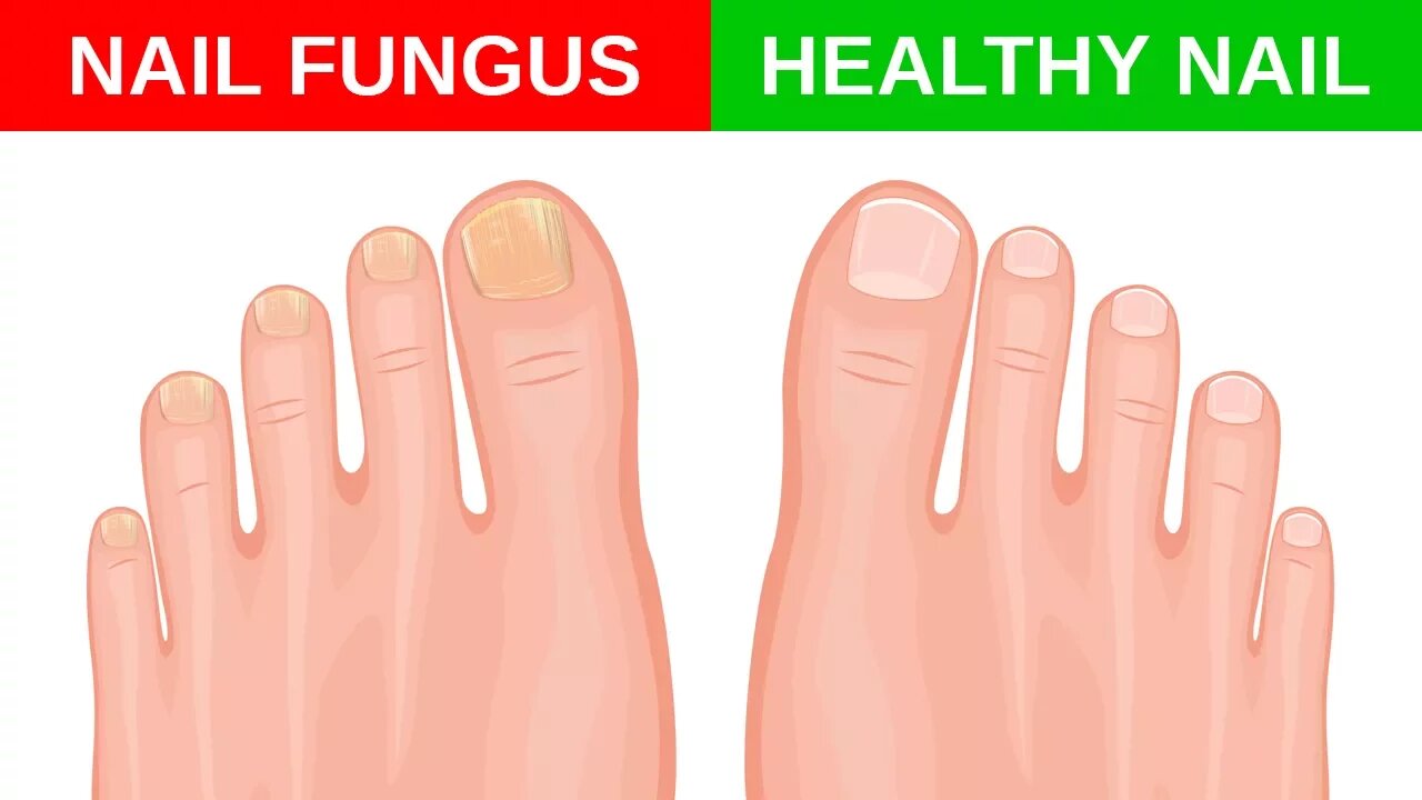 Simple Home Remedies for Toenail Fungus