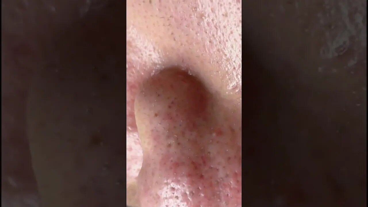 Remoção de Cravos e Espinhas - Remove Squeezing Blackheads and Pimples - Just Relax | Apenas Relaxe