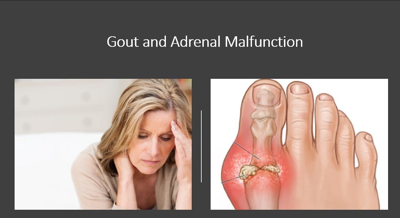 Gout Natural Treatment Options