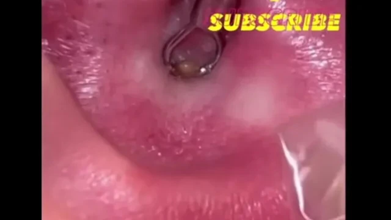 This One Hurt ! - Blackhead Extraction Ear Removal