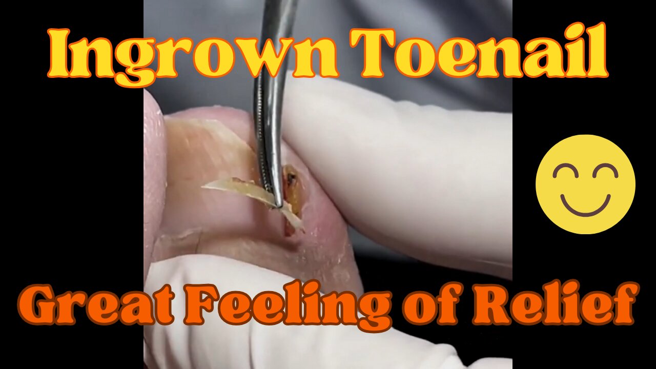 Ingrown Toenail, Great Feeling of Relief