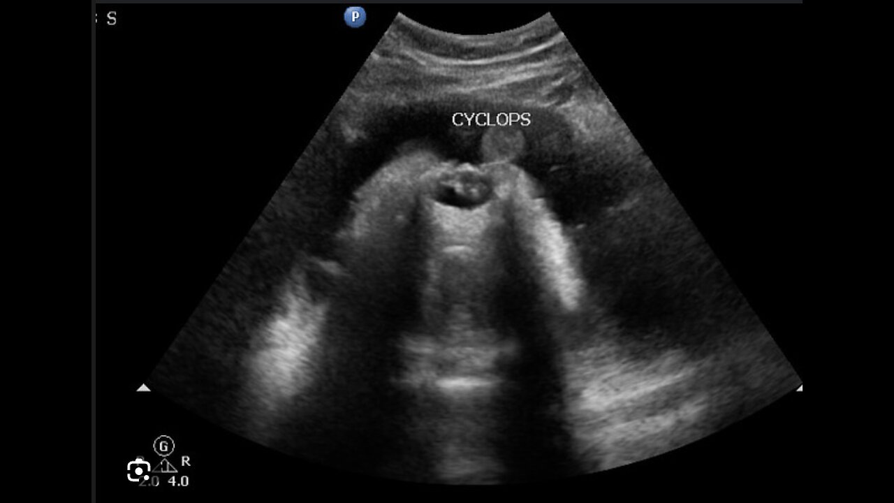 [GRAPHIC IMAGE WARNING] cyclopia - vril type 1 DNA