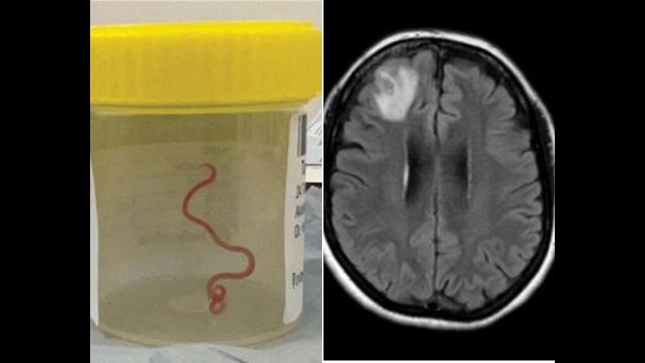 Doctors pull wriggling 8-centimetre live worm from patient's brain during surgery