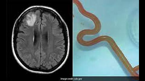 Live worm found in Australian woman_s brain - BBC News