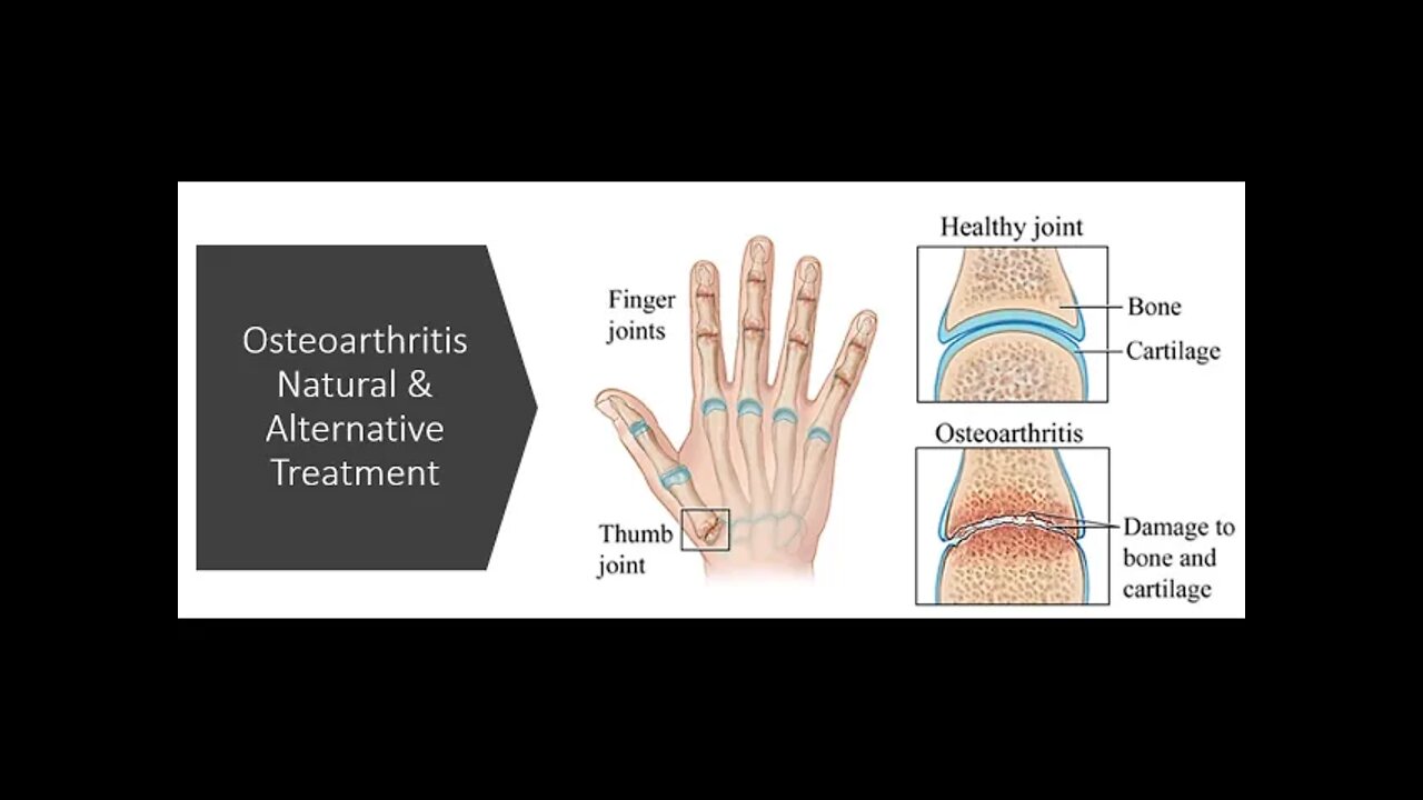 Osteoarthritis - Natural & Alternative Treatment
