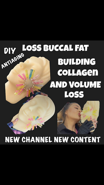 Adding PDO In The Buccal Fat Area building up collagen