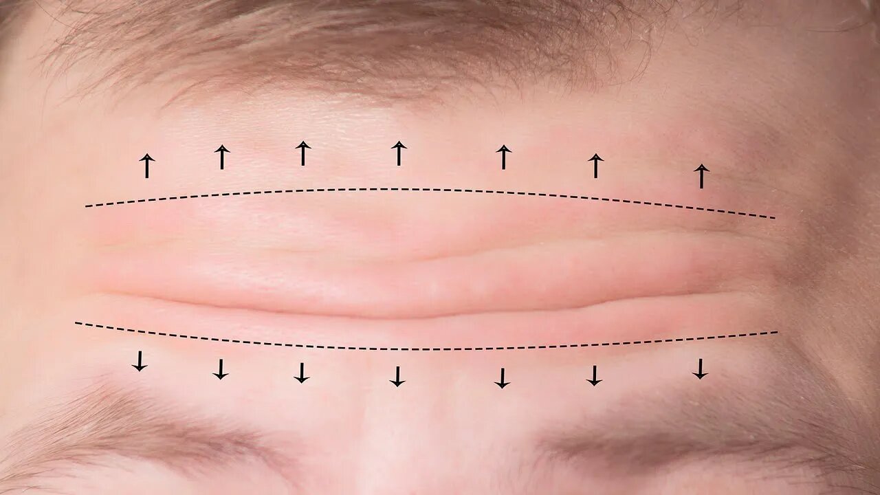 COMO REDUZIR E PREVENIR RUGAS NA TESTA NATURALMENTE