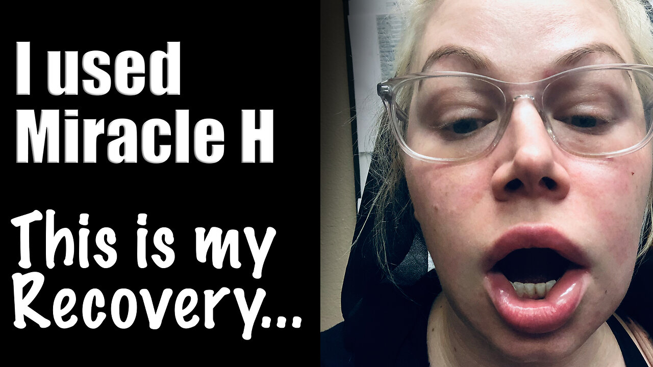 Miracle H Swelling, it happens and it will be OK! Here's my story | Wannabe Beauty Guru