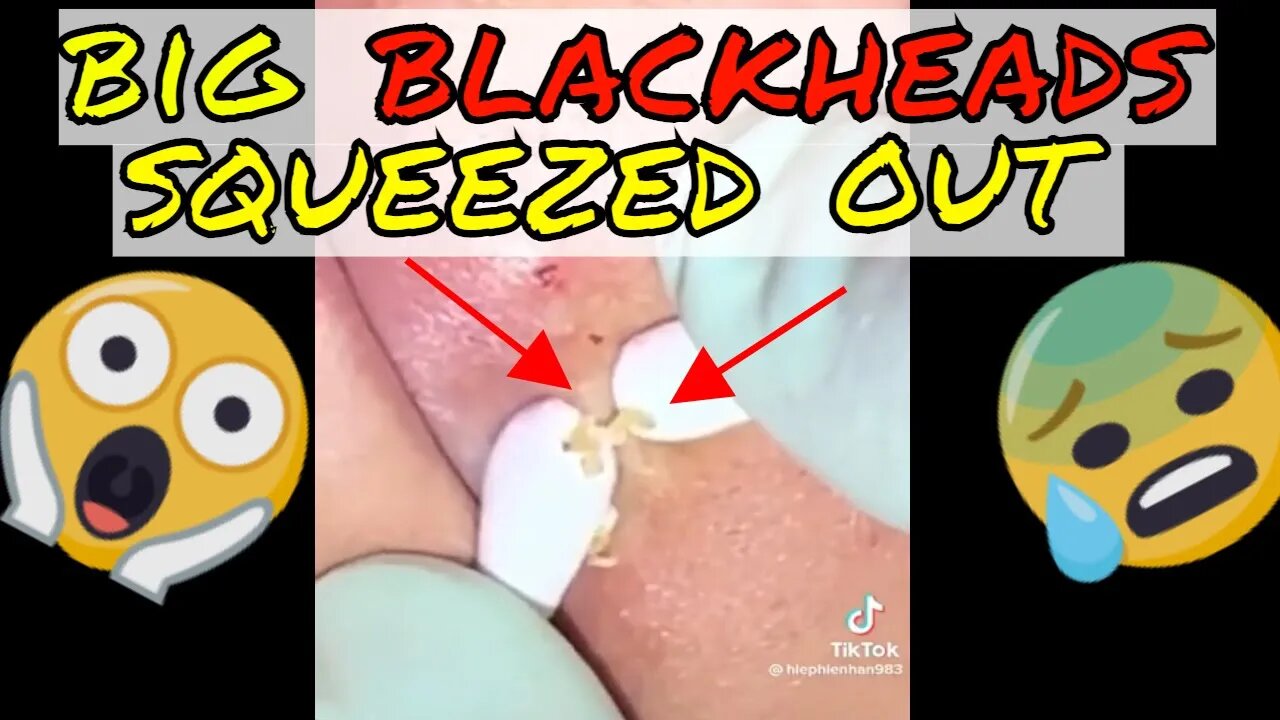 Big blackheads above upper lip squeezed out 😱 #blackheadremoval #blackhead #blackheads #squeezing