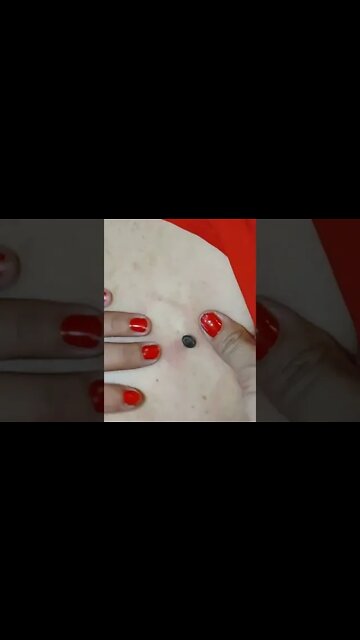 Removing a big old black head