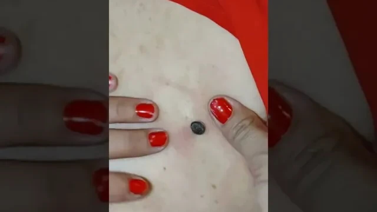 Removing a big old black head