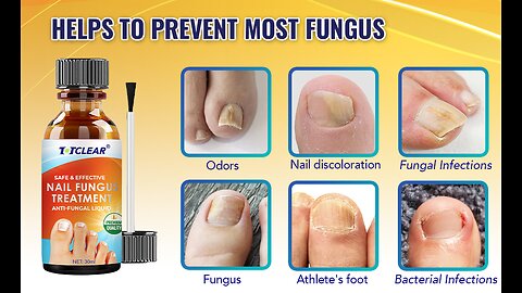 TOTCLEAR Nail Fungus Treatment For Toenail Extra Strength Nail Repair Solution