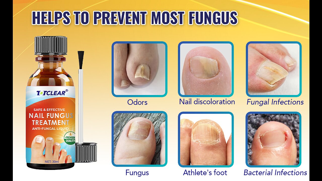 TOTCLEAR Nail Fungus Treatment For Toenail Extra Strength Nail Repair Solution