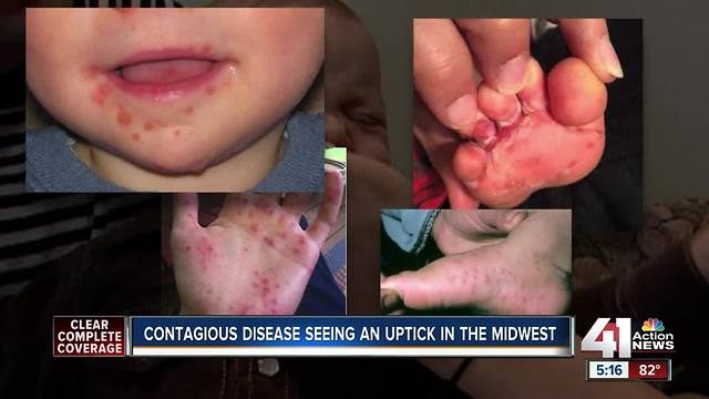 Hand, foot, mouth disease spreading in Midwest