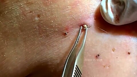 Satisfying video remove blackhead on back