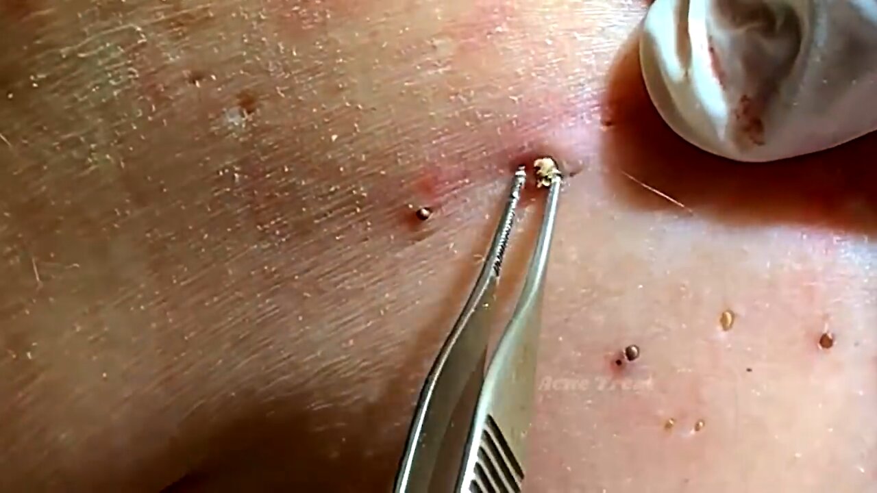 Satisfying video remove blackhead on back