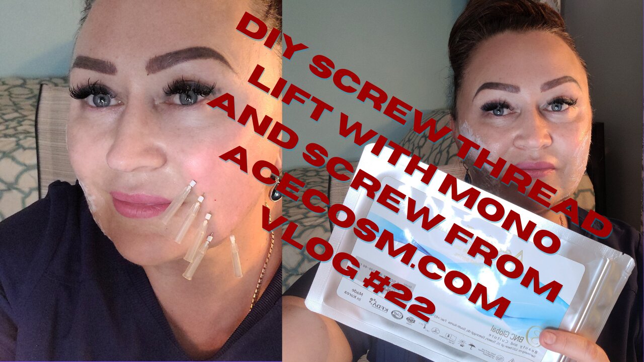 CHEEKS THREAD LIFT AT HOME WITH SCREW! VLOG#22 #threadlift #screw30g38mm #monothreads #pdothreadlif