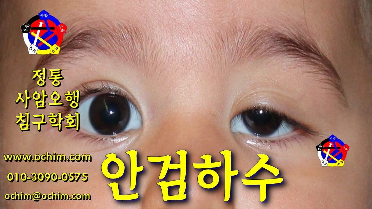 안검하수 치료 방법 - 비과학적 양의학 197 - 사암침, 사암침법, 정통사암침