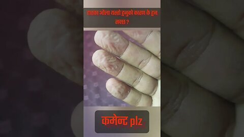 what's happening my fingers?🤔🤔 comment plz #health #viral #youtube #shorts